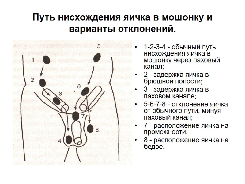 Путь нисхождения яичка в мошонку и варианты отклонений. 1-2-3-4 - обычный путь нисхождения яичка